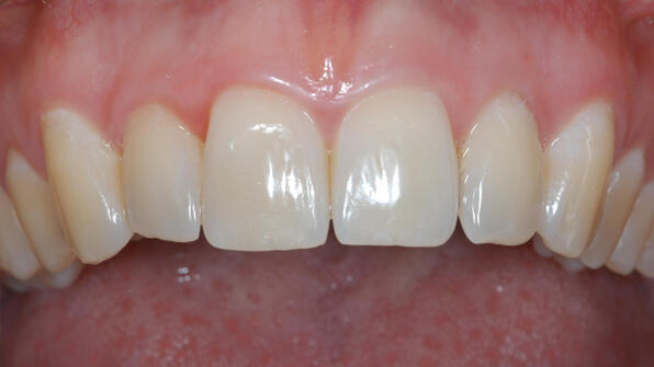 Obere Zahnreihe nach der Behandlung mit einer unsichtbaren Zahnspange mit Invisalign.