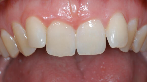 Obere Zahnreihe vor der Behandlung mit einer unsichtbaren Zahnspange mit Invisalign.