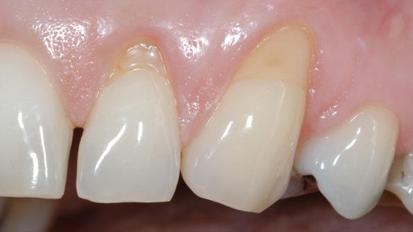 Vorher: freiliegende Zahnhälse
